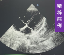 术后一年随访：可降解PFO封堵器介入封堵大量分流的卵圆孔未闭一例