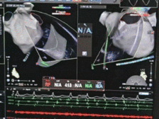 破局传统困境 | 射频房间隔穿刺针在ICE引导下绿色射频穿刺