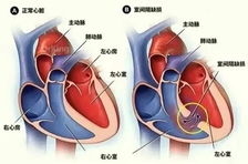 微创破局，修复“心”缺口｜室间隔穿孔介入诊疗，守护心功能防线