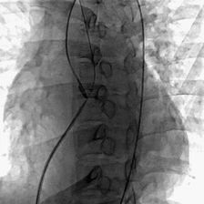 “被当作室间隔缺损”的主动脉窦瘤破裂一例--急性心衰背后的真相