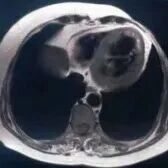 胸闷31年，从“扩张型心肌病”到“左室心肌致密化不全”，这个误诊病例给心内科医生提了个醒