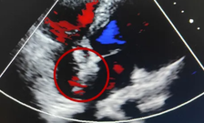 可降解封堵器成功封堵距主动脉无缘且合并软缘的18mm房间隔缺损