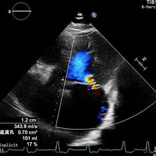 巨大左房AFMR行TEER一例
