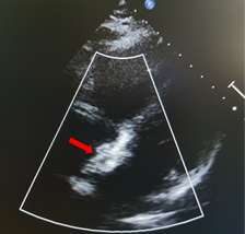 14岁儿童近20mm大型房缺引起间歇式头晕案例-可降解ASD封堵成功