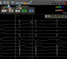 中南大学湘雅医院率先完成心房无导线起搏器Bachmann束区域起搏植入术