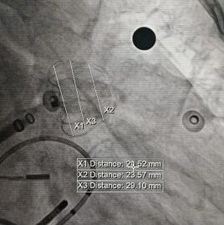 封耳心安 | MemoLefort封堵低位鸡翅左心耳病例分享