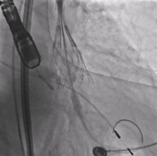 小入路·反流挑战 | 武汉大学人民医院江洪、余锂镭、黄兵教授团队应用ScienCrown完成一例小入路、反流为主TAVR手术