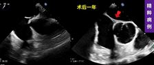 术后1年随访 | 30余年头痛顽疾显著改善：可降解封堵器在长隧道PFO合并膨出瘤中的成功应用