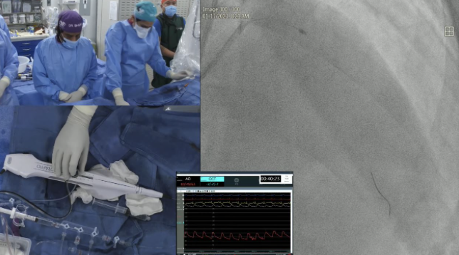 Staged PCI of Calcified LAD/D1 Bifurcation using RotaTripsy and Mini-Crush Stenting – January 2023